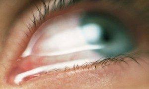 Светобоязнь глаз: причины, лечение, профилактика